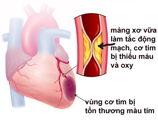 Chứng nhồi máu cơ tim cấp - Hình ảnh minh họa